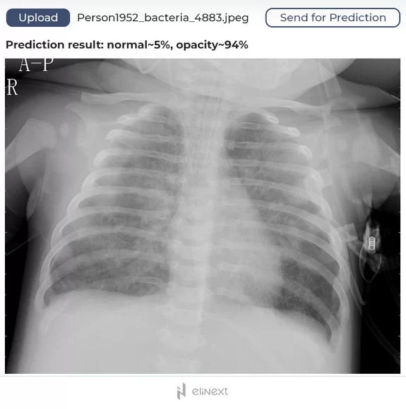 An automated pneumonia diagnosis tool